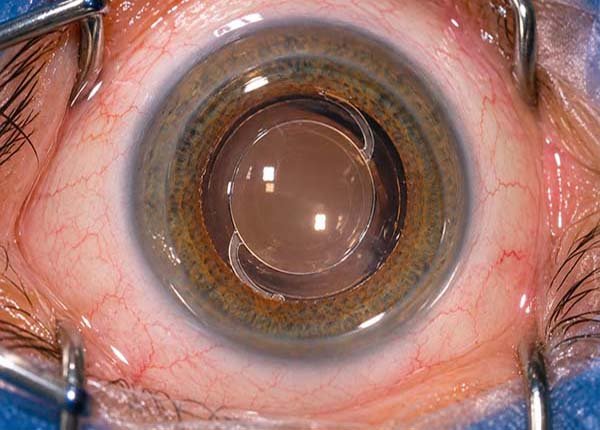 Lente intraocular