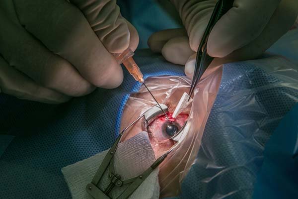 Cirugía de Glaucoma