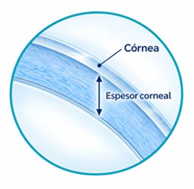 Paquimetría corneal