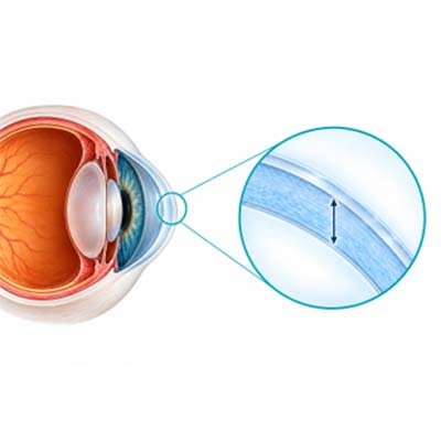 Medición de espesor corneal