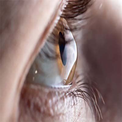 Córnea y superficie ocular