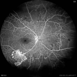 Retinofluoresceinografía - retina