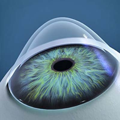 Topógrafo corneal