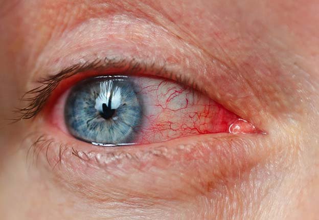 Uveítis e inflamaciones oculares