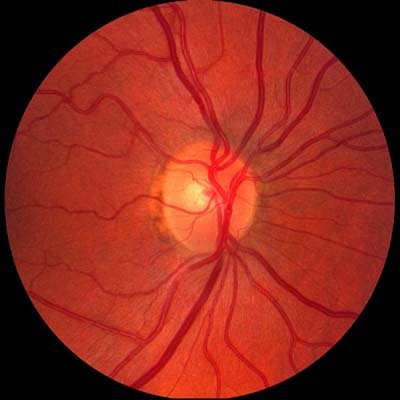 Uveítis e inflamaciones oculares